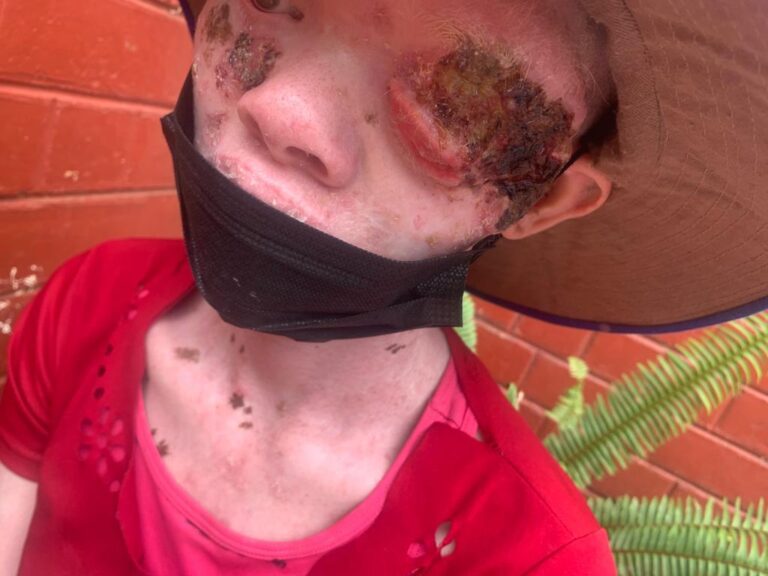 Cancerous growth halts Gutu teenager’s dreams