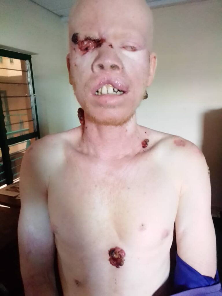 Bocha man calls for help as rare skin cancer troubles him